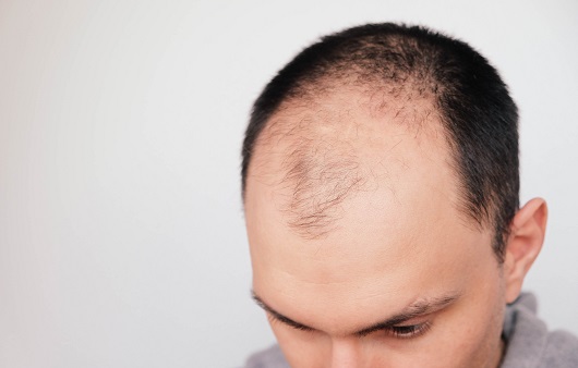 Proven Latest Treatments for Hair Loss and Daily Care Methods (3)