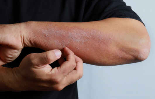 아토피 피부염ㅣ출처: 게티 이미지뱅크