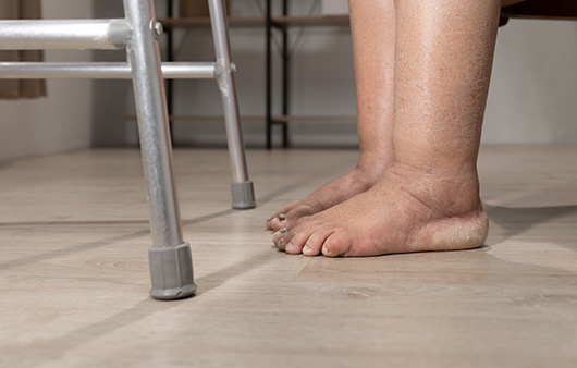 붓는 원인도 제각각인 '림프부종'...적극 치료해야 하는 이유는? < 헬시라이프 < 기사본문 - 하이닥