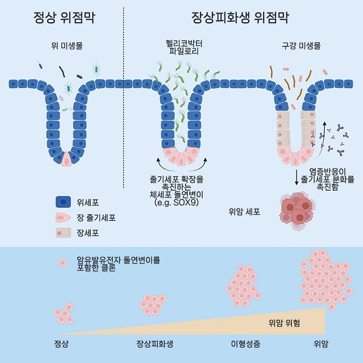 암 시한폭탄 ‘장상피화생’…위암으로 진행되는 사람 특징 규명돼