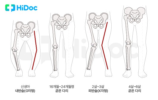 “우리 아이 다리가 휘었어요”…‘O자·X자’로 휜 다리, 문제 없을까?