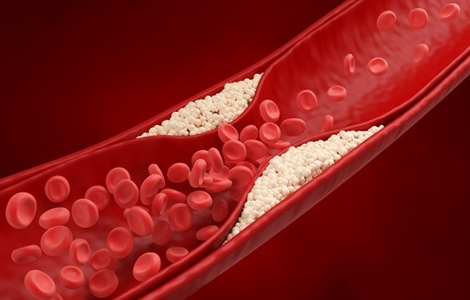 LDL 콜레스테롤은 혈관에 쌓여 동맥경화를 유발한다｜출처: 게티이미지뱅크
