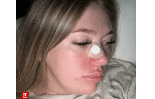 호주 시드니에 거주하는 20대 여성 로렌 스미스. 편평세포암 진단을 받아 국소 항암 화학요법을 받고 있다|출처: 뉴욕포스트 보도 캡처