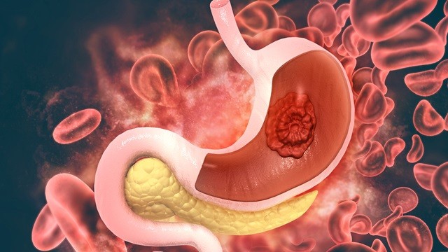 장상피화생을 방치하면 위암으로 번질 수 있다|출처: 게티이미지뱅크