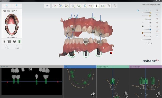 내비게이션 임플란트 식립 전 시술 계획 이미지 | 출처: 림플란트치과의원