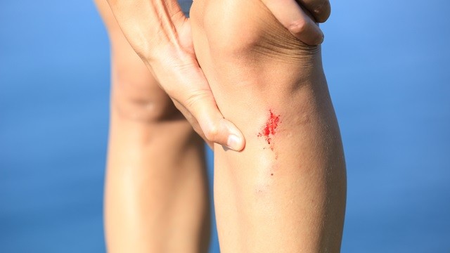 피부에 상처가 생긴 후, 색소나 이물질이 들어가면 외상성 문신이 된다｜출처: 게티이미지뱅크