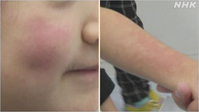일본에서 유행하고 있는 감염성 홍반|출처: NHK 보도 캡처