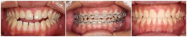 클리피씨 교정 치료 전, 치료 중, 치료 후 사진ㅣ출처: 송파연세굿플란트치과의원