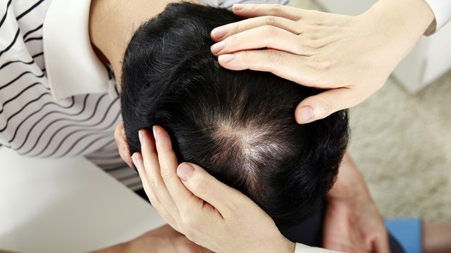 탈모는 많은 현대인들의 고민거리다|출처: 클립아트코리아