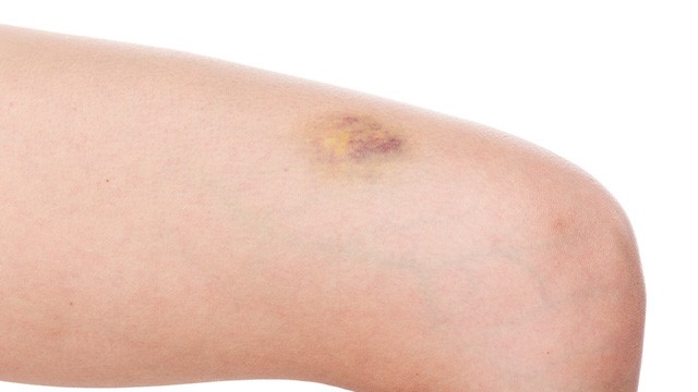 보기 싫은 멍, 올바른 방법으로 관리하면 빠르게 제거할 수 있다｜출처: 게티이미지뱅크