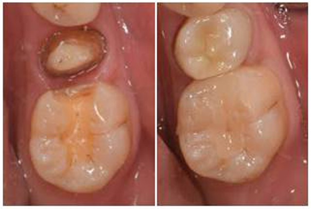 상단 크라운, 하단 인레이 치료 전후 이미지 | 출처: 송파연세굿플란트치과의원