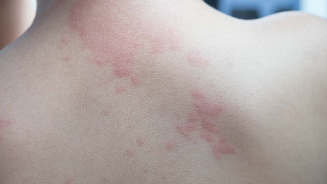 전 세계적으로 홍역이 유행하고 있는 지금. 해외여행을 계획 중인 경우 주의가 당부 된다｜출처: 게티이미지뱅크