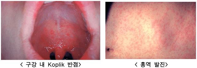 출처: 미국질병관리본부(Centers for Disease Control and Prevention)
