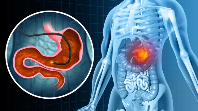 위내시경 검사는 기질적 병변을 배제하는 가장 기본적인 방법이다ㅣ출처: 게티이미지뱅크