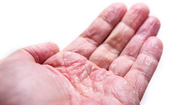 건조한 겨울 날씨는 주부습진의 악화를 일으킨다. | 출처: 클립아트코리아