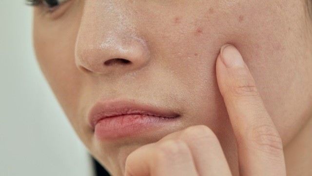 여드름과 흉터 고민을 하는 사람을 흔하게 찾아볼 수 있다ㅣ출처: 클립아트코리아