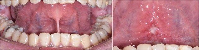 설소대 수술 전후 이미지ㅣ출처: 송파연세굿플란트치과의원
