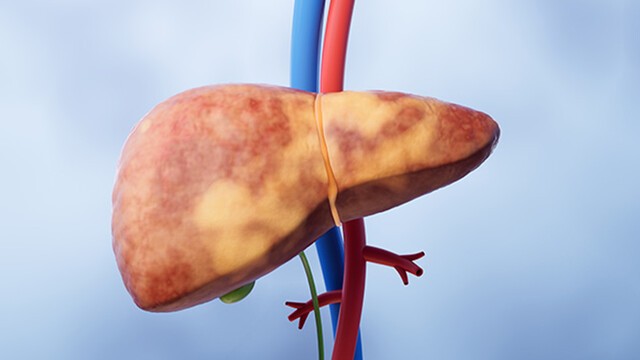 성인에서 흔한 지방간은 합병증을 야기할 수 있어 적극적인 관리가 필요하다|출처: 게티이미지뱅크