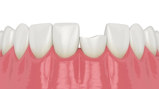 부러진 치아의 상태에 따라 신경치료나 발치가 필요한 경우도 있다ㅣ출처: 게티이미지뱅크