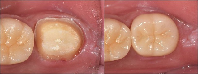 레진코어 치료 전후 이미지 | 출처: 송파연세굿플란트치과의원