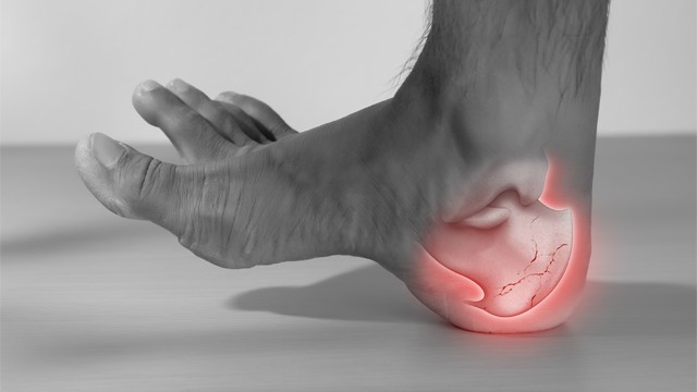 피로 골절은 일반 골절과는 다르게 강한 충격 없이도 발생한다 | 출처: 게티이미지뱅크