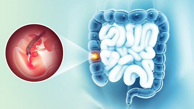 ﻿대장내시경 검사는 대장암을 비롯한 대장 질환을 예방·조기발견할 수 있는 방법이다｜출처: 게티이미지뱅크