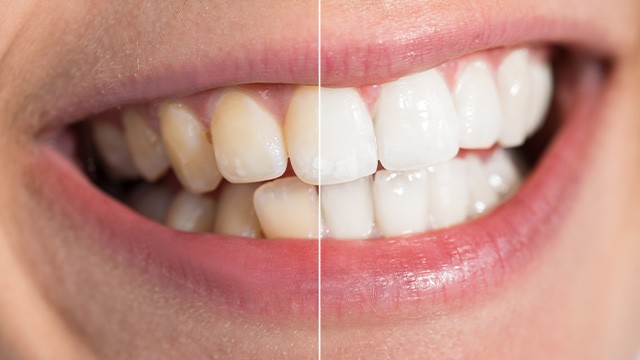 ﻿치아가 변색됐다면 이를 유발하는 생활습관이 있는지 되돌아 봐야 한다｜출처: 클립아트코리아