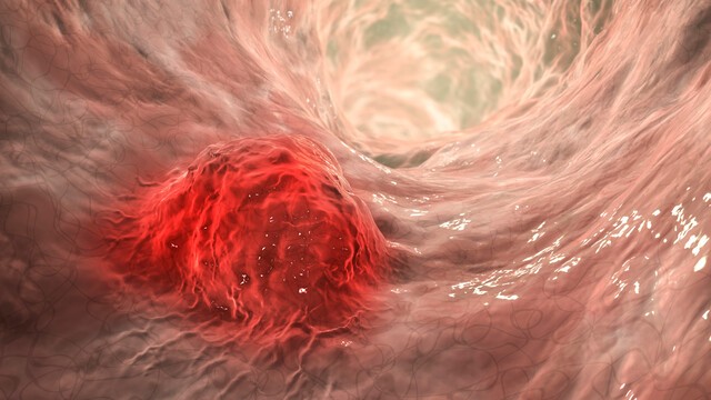 ﻿고주파온열암치료는 암세포를 선택적으로 제거하는 치료법이다｜출처: 클립아트코리아