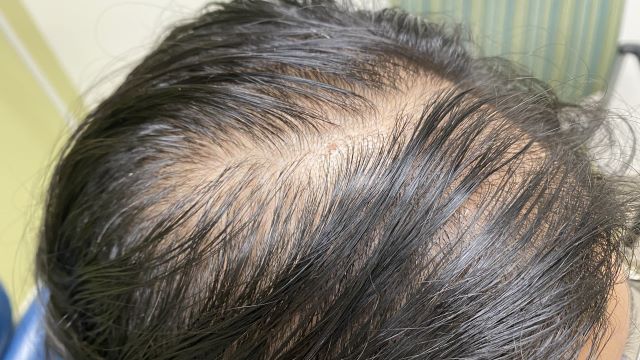 머리카락이 얇아지는 데에는 다양한 원인이 있다 | 출처: 클립아트코리아