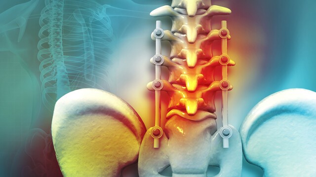 ﻿척추관 협착증은 엉덩이 통증을 비롯해 다양한 증상을 야기할 수 있다｜출처: 게티이미지뱅크