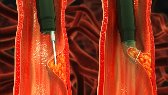 대장 용종을 제거하는 방법은 크기와 형태에 따라 달라진다 | 출처: 게티이미지뱅크