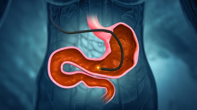 꾸준한 내시경 검사를 통해 암을 조기 진단하고 예방할 수 있다｜출처: 게티이미지뱅크