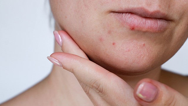 모낭염은 약해진 피부 속으로 세균 등이 침투해 발생한다 ㅣ출처: 게티이미지뱅크