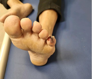 당뇨발 초기 증상|출처: 혜민병원 당뇨발센터