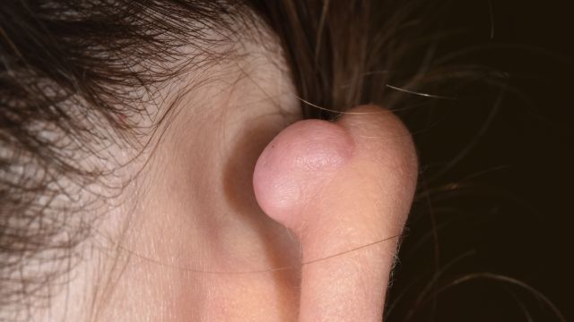 켈로이드는 혹 모양으로 자라난다｜출처: 클립아트코리아