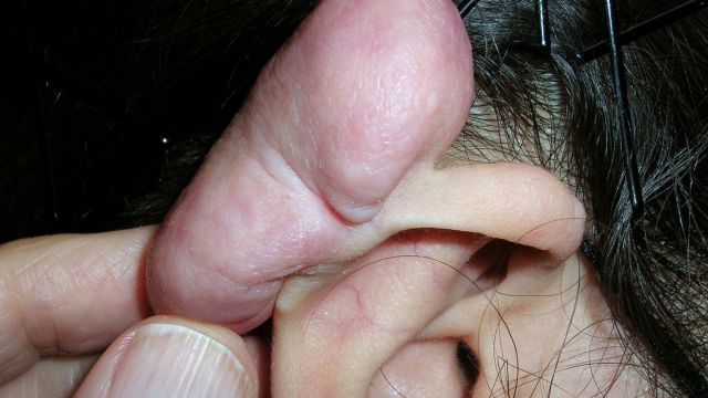 켈로이드는 자연 치유되는 경우가 드물다 ｜출처: 클립아트코리아