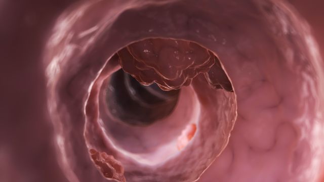 대장암은 용종 크기에 따라 증상 정도가 달라진다 |출처: 클립아트코리아