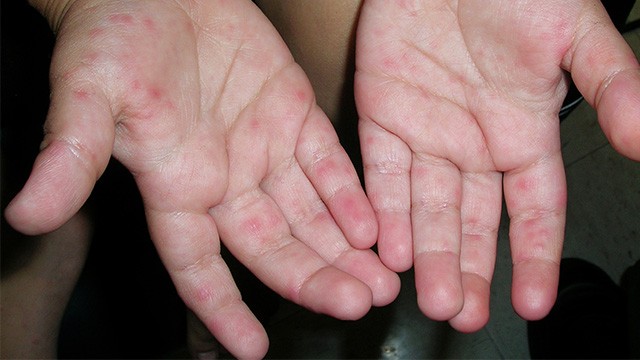 수족구병은 봄부터 여름까지 유행하는 바이러스성 감염병이다|출처: 클립아트코리아