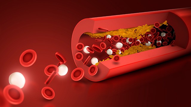 고지혈증은 몸 전체의 장기에 영향을 줄 수 있는 질환이다｜출처: 클립아트코리아