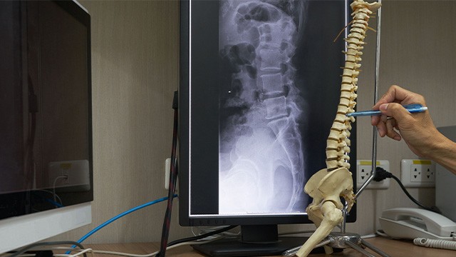 척추 수술은 자신의 상태에 맞게 선택하는 것이 중요하다|출처: 게티이미지뱅크
