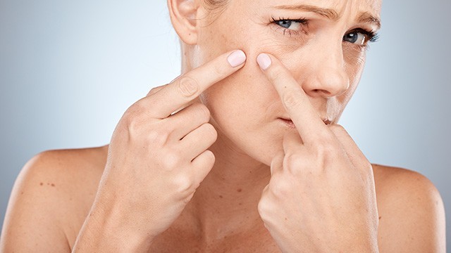 ﻿피지낭종이 생기면 짜고 싶은 충동이 들 수 있지만, 피부 건강을 위해 참아야 한다｜출처: 게티이미지뱅크