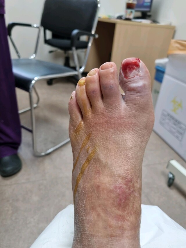 발톱 혈종 감염 환자의 발|출처: 혜민병원 당뇨발 센터