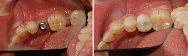 ﻿30대 임플란트 수술 전후 이미지 | 출처: 림플란트치과의원