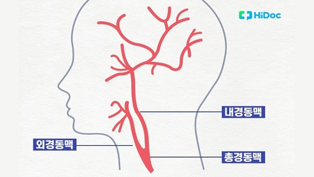경동맥|출처: 하이닥