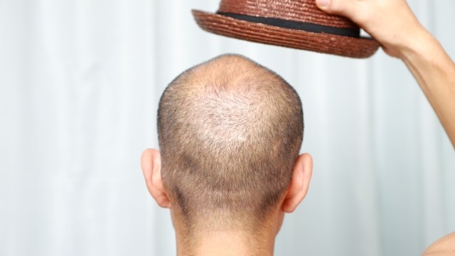 모자를 자주 쓰면 머리카락이 더 많이 빠질까?｜출처: 게티이미지뱅크