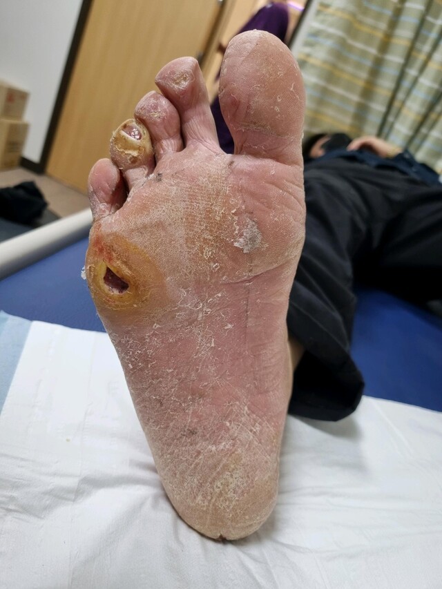 무심코 지나친 굳은살이 큰 문제로 진행할 수 있다｜출처: 혜민병원