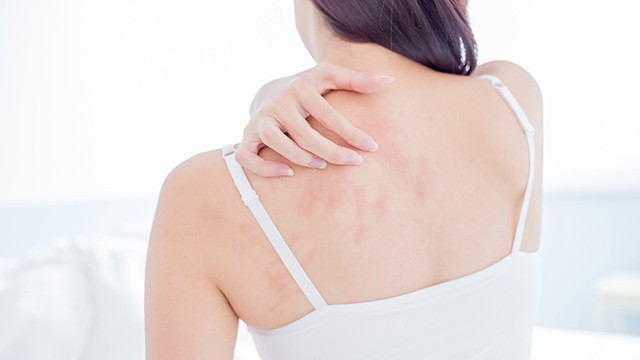 햇빛 알레르기란 자외선(UV)에 노출된 후 피부에 염증성 반응이 일어나는 상태를 말한다｜출처: 클립아트코리아