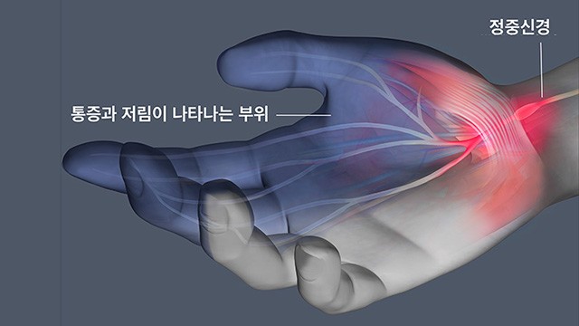 정중신경은 목에서 손끝까지 이어지는 대표적인 말초신경 중 하나로, 손의 감각과 운동을 담당한다｜출처: 클립아트코리아