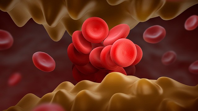 이상지질혈증은 꾸준히 관리해야 하는 만성질환이다|출처: 클립아트코리아