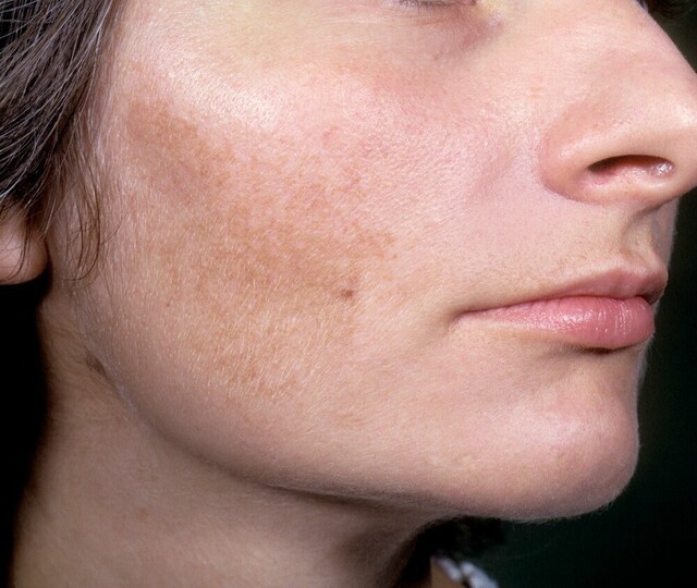 색소 침착 피부 | 출처: 클립아트코리아